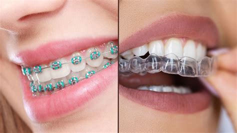 diferencia entre brackets metalicos y autoligables|diferencia entre brackets y ligas.